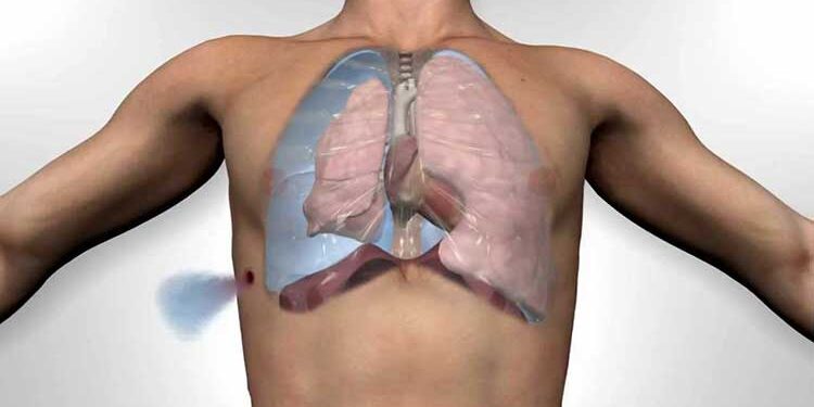 Akciğer Ameliyatı Olanların Yorumları