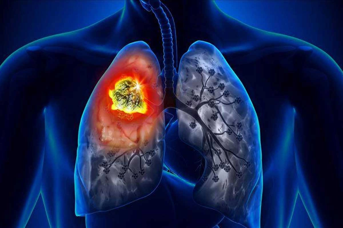 Akciğer Kanserinden Kurtulanların Yorumları