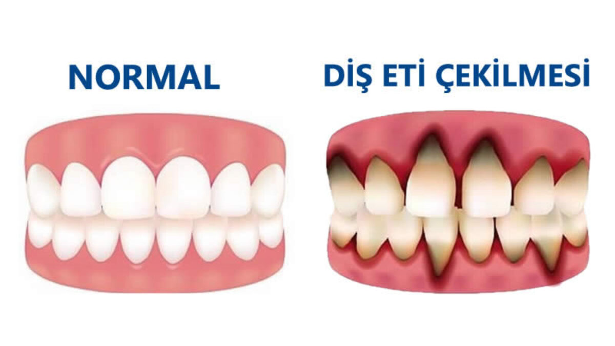 Diş Eti Çekilmesi Ameliyatı Olanların Yorumları