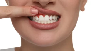 Diş Eti Çekilmesi Yorumları