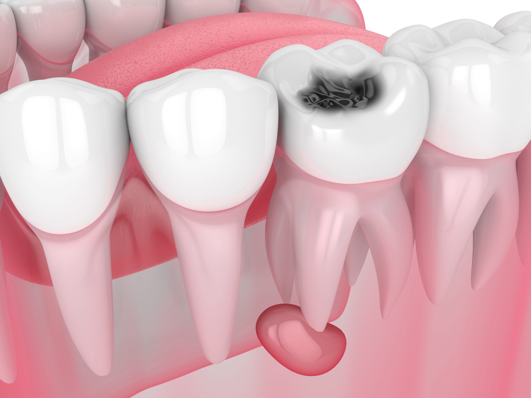 Diş Kisti Ameliyatı Olanların Yorumları
