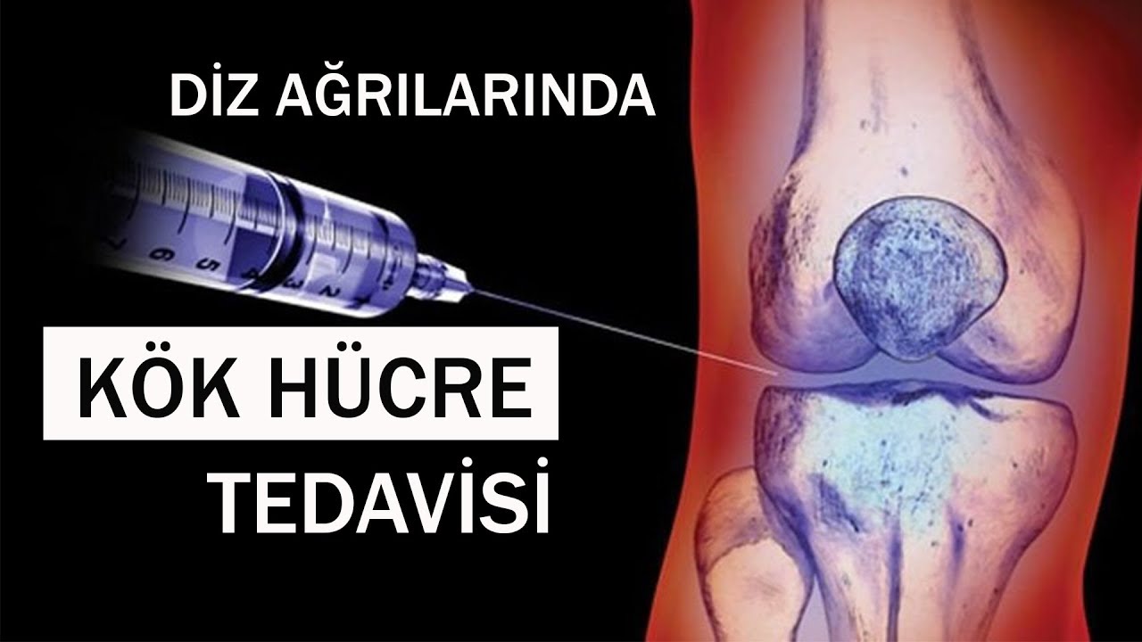 Dize Kök Hücre Yaptıranların Yorumları