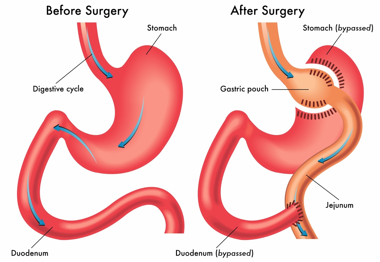 Gastrik Bypass Ameliyatı Olanların Yorumları