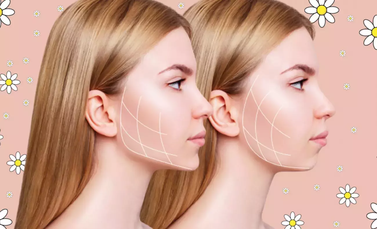 Jawline dolgusu nedir? Jawline dolgusu nasıl yapılır?