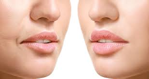 Lip Lift (Dudak Kaldırma) Ameliyatı ile Yüze Estetik Bir Dokunuş