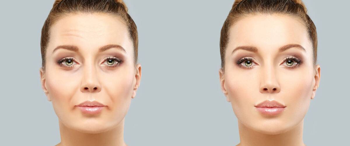 Nazolabial Dolgu Mucizesi İle Tanıştınız mı?