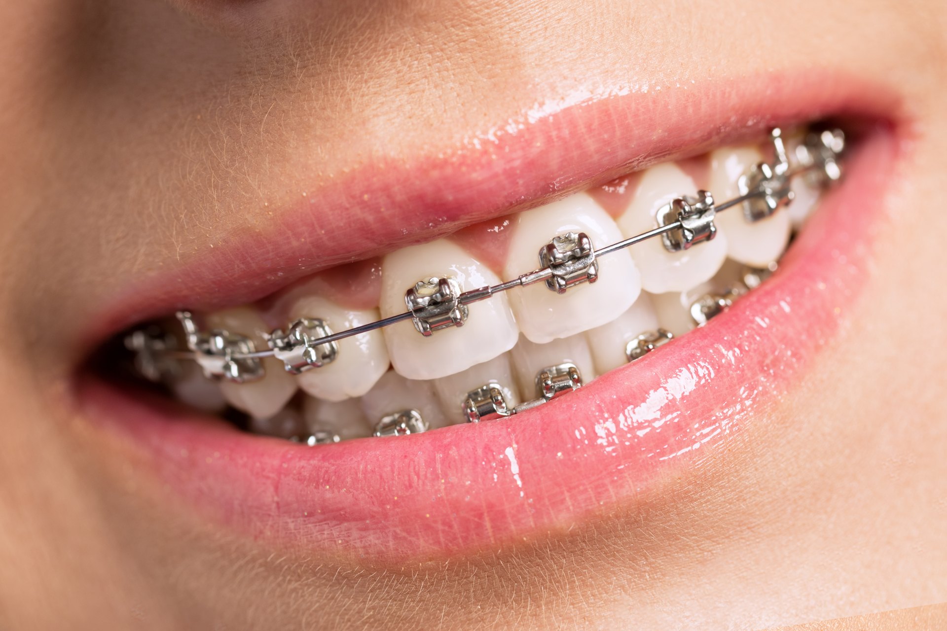 Ortodonti Tedavisi ile Birlikte İmplant Tedavisi Uygulanabilir mi?