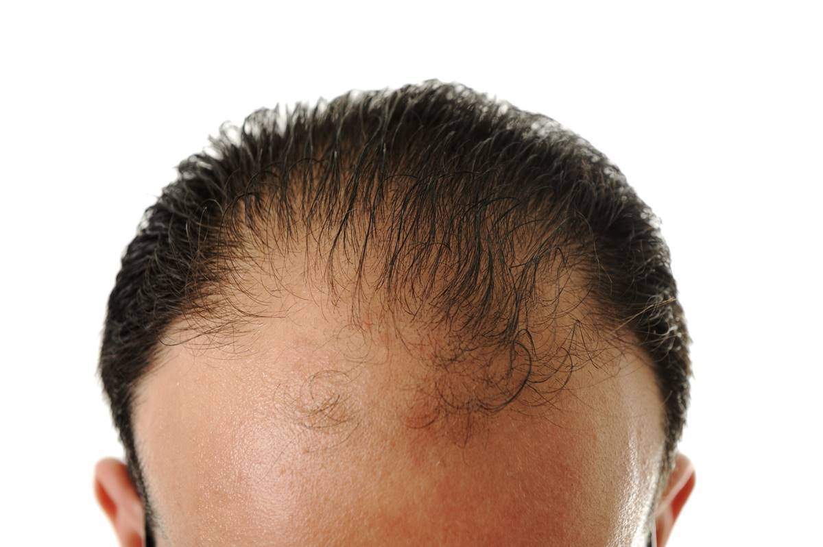 Saç Ekimi Kalıcı Bir Uygulama mıdır?