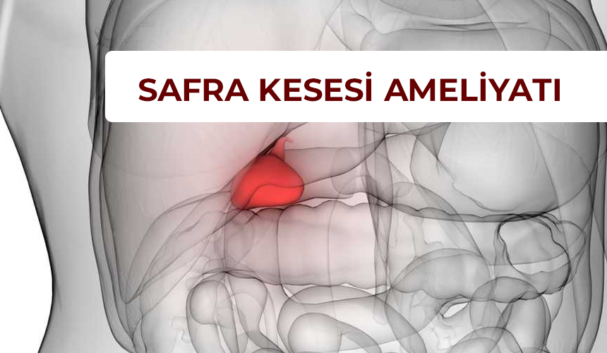 Safra Kesesi Ameliyatı Olanlarin Yorumları