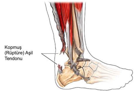 Tendon Ameliyatı Olanların Yorumları